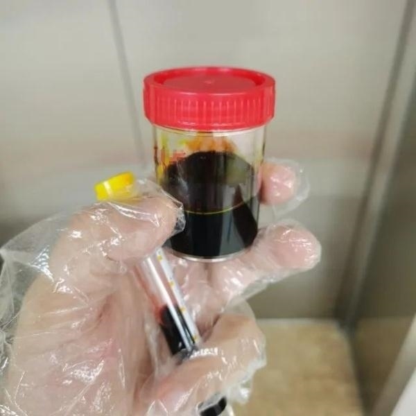 急性肝衰竭！兩兄弟誤吃這種菌 專家提醒