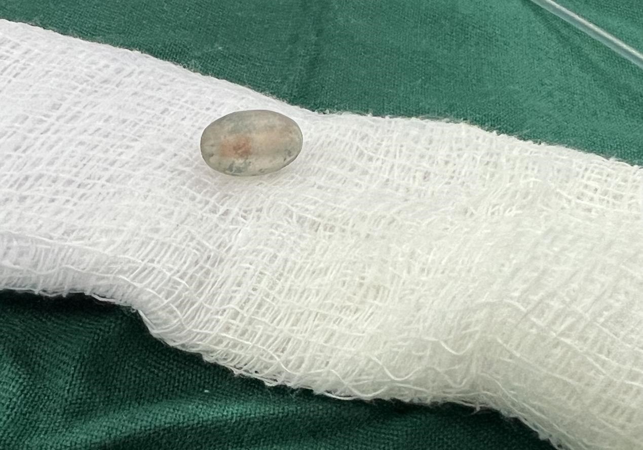 被取出的異物。中國援桑醫(yī)療隊(duì)供圖