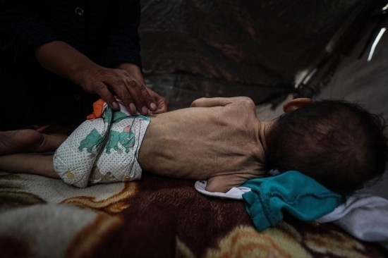 這是5月28日在加沙城西部一處臨時(shí)安置點(diǎn)拍攝的一名營養(yǎng)不良的嬰兒。新華社發(fā)（馬哈茂德·扎基攝）